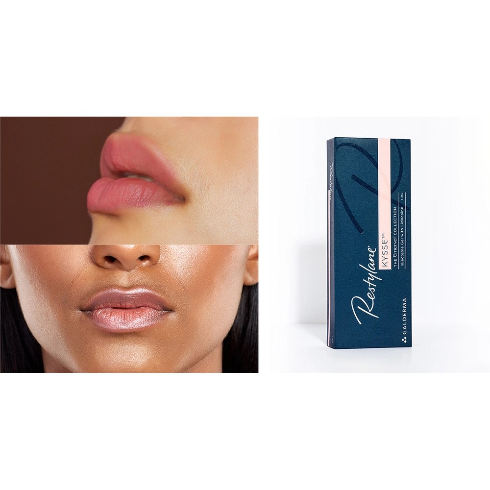 Restylane Kysse with Lidocaine